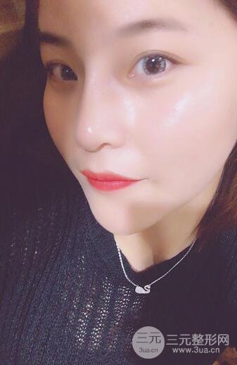 隆鼻鼻翼縮小全過程和術(shù)后照片分享,隨意揉捏很OK