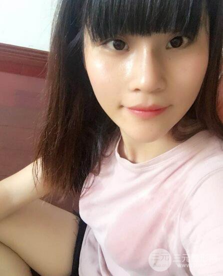 隆鼻鼻翼縮小全過程和術(shù)后照片分享,隨意揉捏很OK