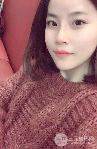 隆鼻鼻翼縮小全過程和術(shù)后照片分享,隨意揉捏很OK