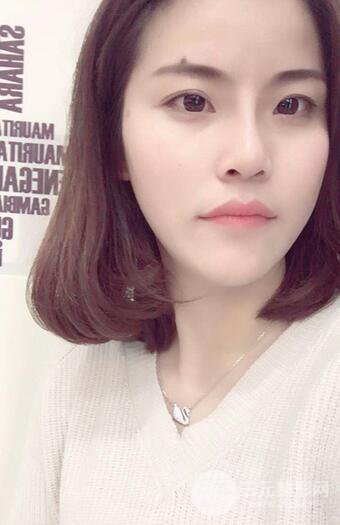 隆鼻鼻翼縮小全過程和術(shù)后照片分享,隨意揉捏很OK