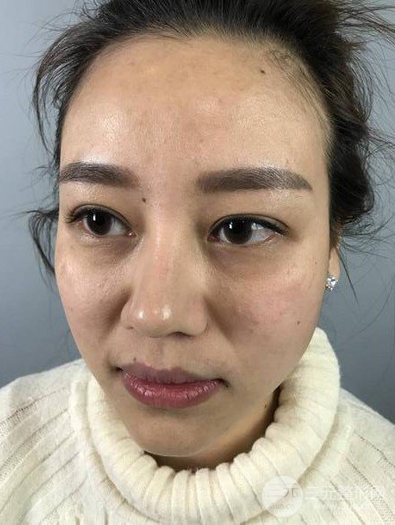 【高強(qiáng)度聚焦超聲面b提升術(shù)后照片】原來我的青春并沒有走遠(yuǎn)~