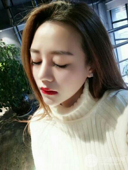 【高強(qiáng)度聚焦超聲面b提升術(shù)后照片】原來我的青春并沒有走遠(yuǎn)~