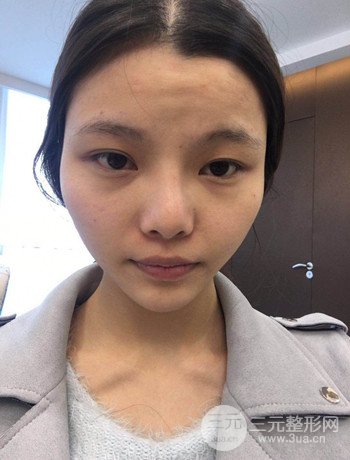 全臉自體脂肪填充+隆鼻整形果永.久保持、丑小鴨變天鵝不是夢