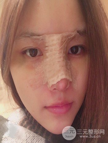 全臉自體脂肪填充+隆鼻整形果永.久保持、丑小鴨變天鵝不是夢