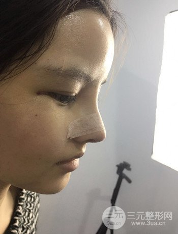 全臉自體脂肪填充+隆鼻整形果永.久保持、丑小鴨變天鵝不是夢