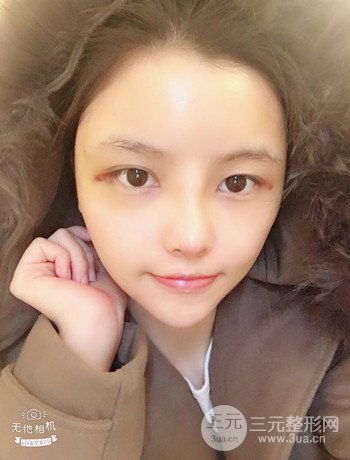 全臉自體脂肪填充+隆鼻整形果永.久保持、丑小鴨變天鵝不是夢