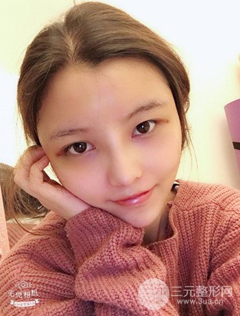 全臉自體脂肪填充+隆鼻整形果永.久保持、丑小鴨變天鵝不是夢