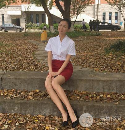 芭比電雙眼皮多項(xiàng)整形術(shù)后分享,雙眼皮拯救死魚眼!