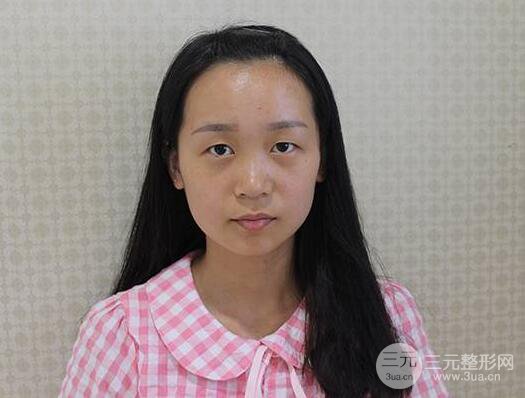 芭比電雙眼皮多項(xiàng)整形術(shù)后分享,雙眼皮拯救死魚眼!