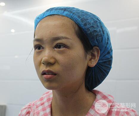 芭比電雙眼皮多項(xiàng)整形術(shù)后分享,雙眼皮拯救死魚眼!