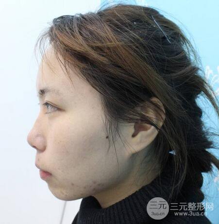 自體脂肪填充全臉基本換臉，改臉型不只是磨骨才能做到！