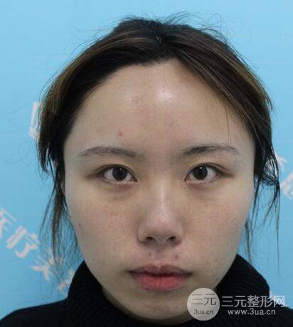 自體脂肪填充全臉基本換臉，改臉型不只是磨骨才能做到！