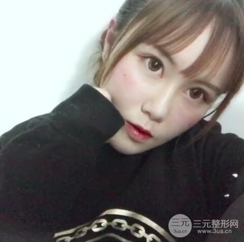 自體脂肪填充全臉基本換臉，改臉型不只是磨骨才能做到！