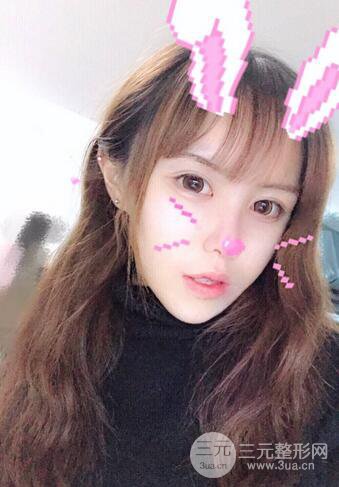 自體脂肪填充全臉基本換臉，改臉型不只是磨骨才能做到！