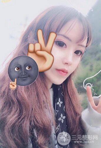 自體脂肪填充全臉基本換臉，改臉型不只是磨骨才能做到！