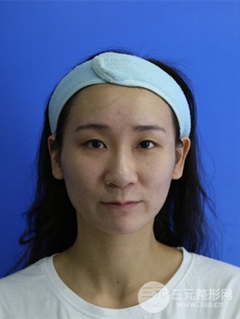 面部埋埋蛋白線.提升改良皮膚松弛，立現(xiàn)小V臉