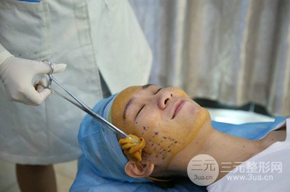 面部埋埋蛋白線.提升改良皮膚松弛，立現(xiàn)小V臉