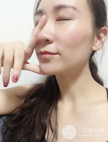 面部埋埋蛋白線.提升改良皮膚松弛，立現(xiàn)小V臉