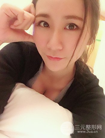 面部埋埋蛋白線.提升改良皮膚松弛，立現(xiàn)小V臉