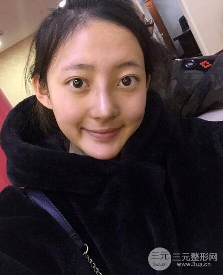 肋軟骨隆鼻+歪鼻矯正案例