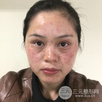 廣州激光祛雀斑果不反彈、恢復(fù)過(guò)程圖片分享