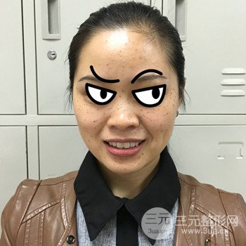 廣州激光祛雀斑果不反彈、恢復(fù)過(guò)程圖片分享