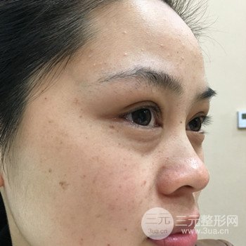 廣州激光祛雀斑果不反彈、恢復(fù)過(guò)程圖片分享