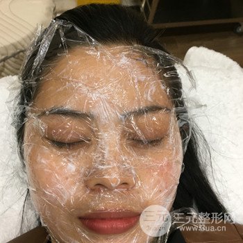 廣州激光祛雀斑果不反彈、恢復(fù)過(guò)程圖片分享