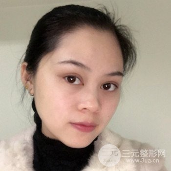 廣州激光祛雀斑果不反彈、恢復(fù)過(guò)程圖片分享