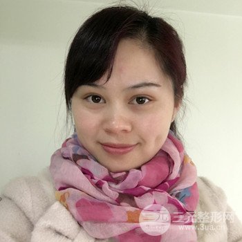 廣州激光祛雀斑果不反彈、恢復(fù)過(guò)程圖片分享