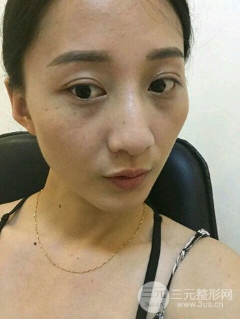 朱彤玥激光祛斑案例、兩個月果對比超明X