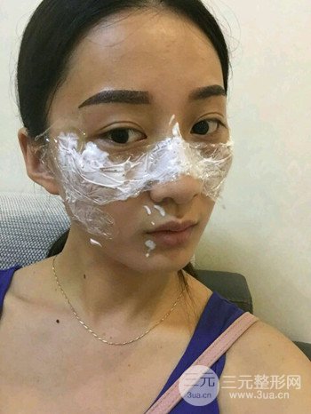 朱彤玥激光祛斑案例、兩個月果對比超明X