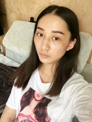 朱彤玥激光祛斑案例、兩個月果對比超明X