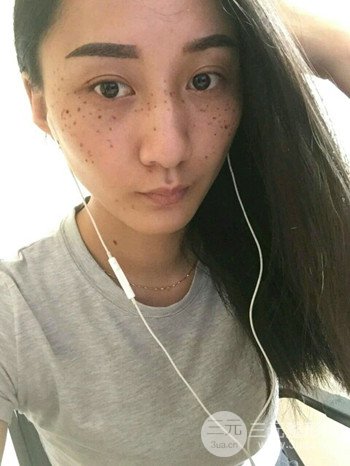 朱彤玥激光祛斑案例、兩個月果對比超明X