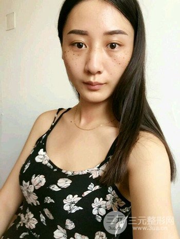 朱彤玥激光祛斑案例、兩個月果對比超明X