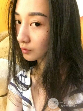 朱彤玥激光祛斑案例、兩個月果對比超明X