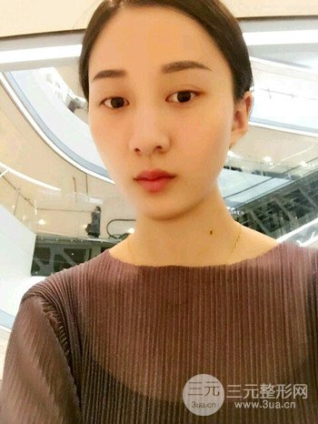 朱彤玥激光祛斑案例、兩個月果對比超明X