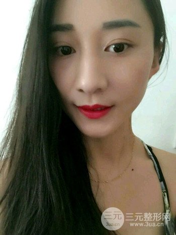 朱彤玥激光祛斑案例、兩個月果對比超明X