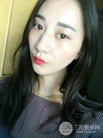 朱彤玥激光祛斑案例、兩個月果對比超明X