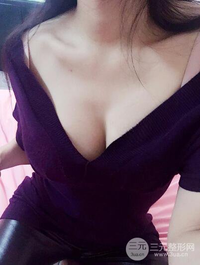 自體脂肪納米豐胸三個(gè)月術(shù)后果展示(附圖)