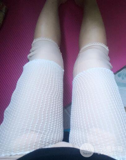 自體脂肪納米豐胸三個(gè)月術(shù)后果展示(附圖)