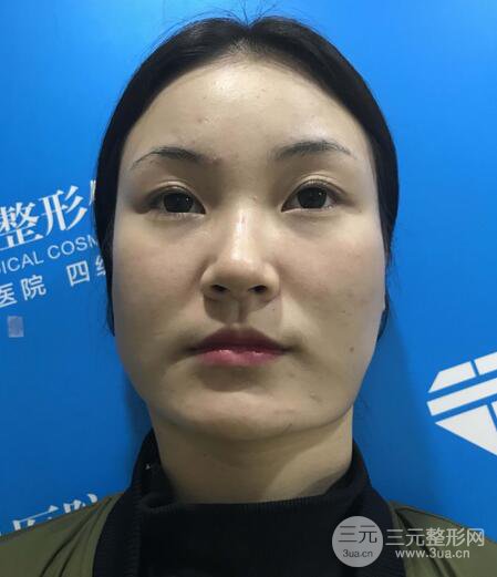 下頜角磨骨整形全過程分享，附上術后恢復照片~