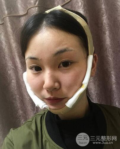 下頜角磨骨整形全過程分享，附上術后恢復照片~