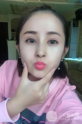 硅膠隆鼻術(shù)前術(shù)后對(duì)比照片分享,走上顏值頂峰