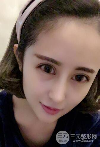 硅膠隆鼻術(shù)前術(shù)后對(duì)比照片分享,走上顏值頂峰