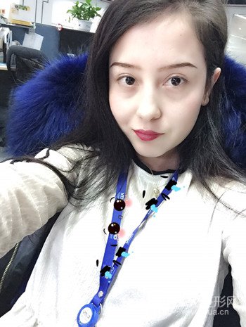 廣州內(nèi)切去眼袋術(shù)后恢復過程案例對比分享