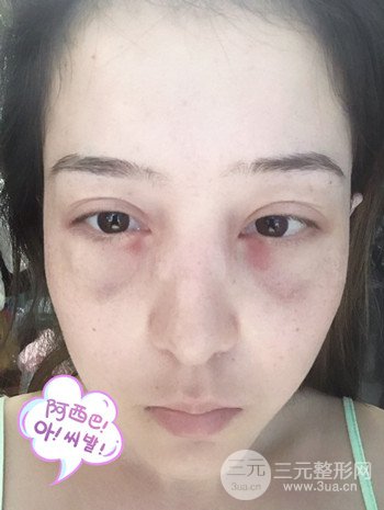 廣州內(nèi)切去眼袋術(shù)后恢復過程案例對比分享