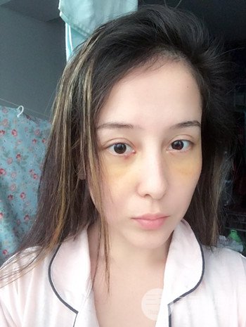 廣州內(nèi)切去眼袋術(shù)后恢復過程案例對比分享