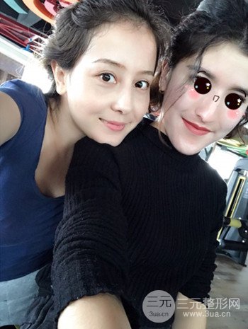 廣州內(nèi)切去眼袋術(shù)后恢復過程案例對比分享