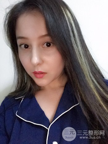 廣州內(nèi)切去眼袋術(shù)后恢復過程案例對比分享